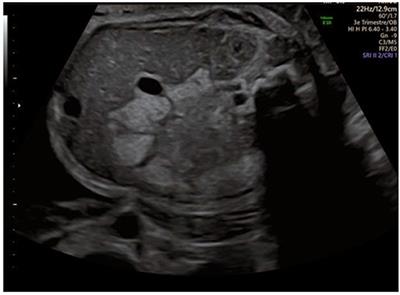 Hyperechoic Content of the Fetal Colon Is Not Always Cystinuria—Case Report